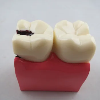 NOVÉ 1PCS 6X Protézy Zuby Model Kazu Porovnanie Model vzniku Zubného Kazu Model Zubár Patológií Pre Lekárske Vedy Vyučovania