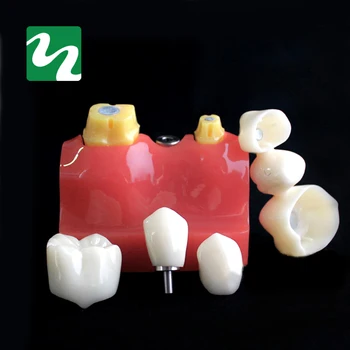 1 ks 4-krát Výsadbu Zuby Model Ústne Vyučovanie Model Zubné Patológia Model Pre Stomatológiu Lab