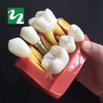 1 ks 4-krát Výsadbu Zuby Model Ústne Vyučovanie Model Zubné Patológia Model Pre Stomatológiu Lab