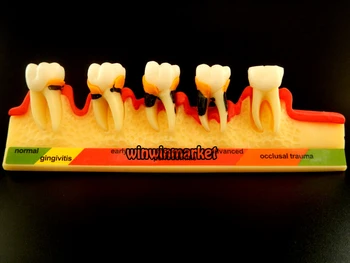 5 Fáze Zubár Odontologia Periodontal Choroby Zubné Zuby Model Zuba ZYR-4010