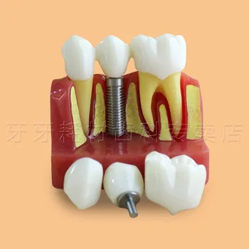 Kvalitné Štyrikrát Zväčšenie Transparentné Zubný Implantát Model,Zub Model,Zubný Implantát Praxi Model
