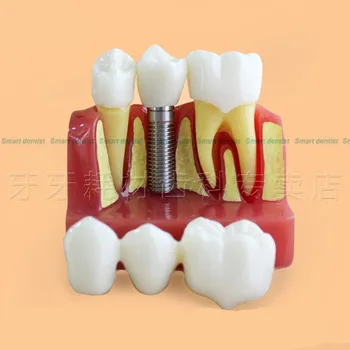 Kvalitné Štyrikrát Zväčšenie Transparentné Zubný Implantát Model,Zub Model,Zubný Implantát Praxi Model