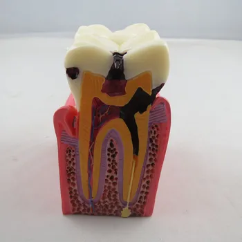 NOVÉ 1PCS 6X Protézy Zuby Model Kazu Porovnanie Model vzniku Zubného Kazu Model Zubár Patológií Pre Lekárske Vedy Vyučovania