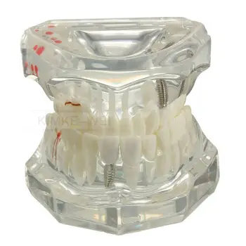 Snímateľné Zubné Náhrady Ochorenia Výučby Zuby Model & Obnova Mosta Zub