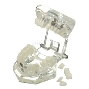 Snímateľné Zubné Náhrady Ochorenia Výučby Zuby Model & Obnova Mosta Zub